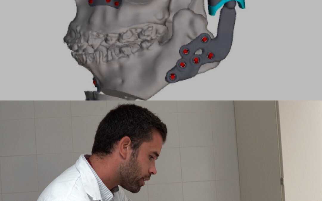 Bellvitge revoluciona la cirurgia maxil·lofacial amb una pròtesi única que transforma la vida d’una jove pacient